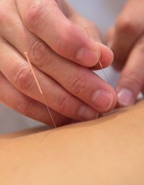 Acupuncture in the Treatment of Alzheimer’s Acupuncture in the Treatment of Alzheimer’s